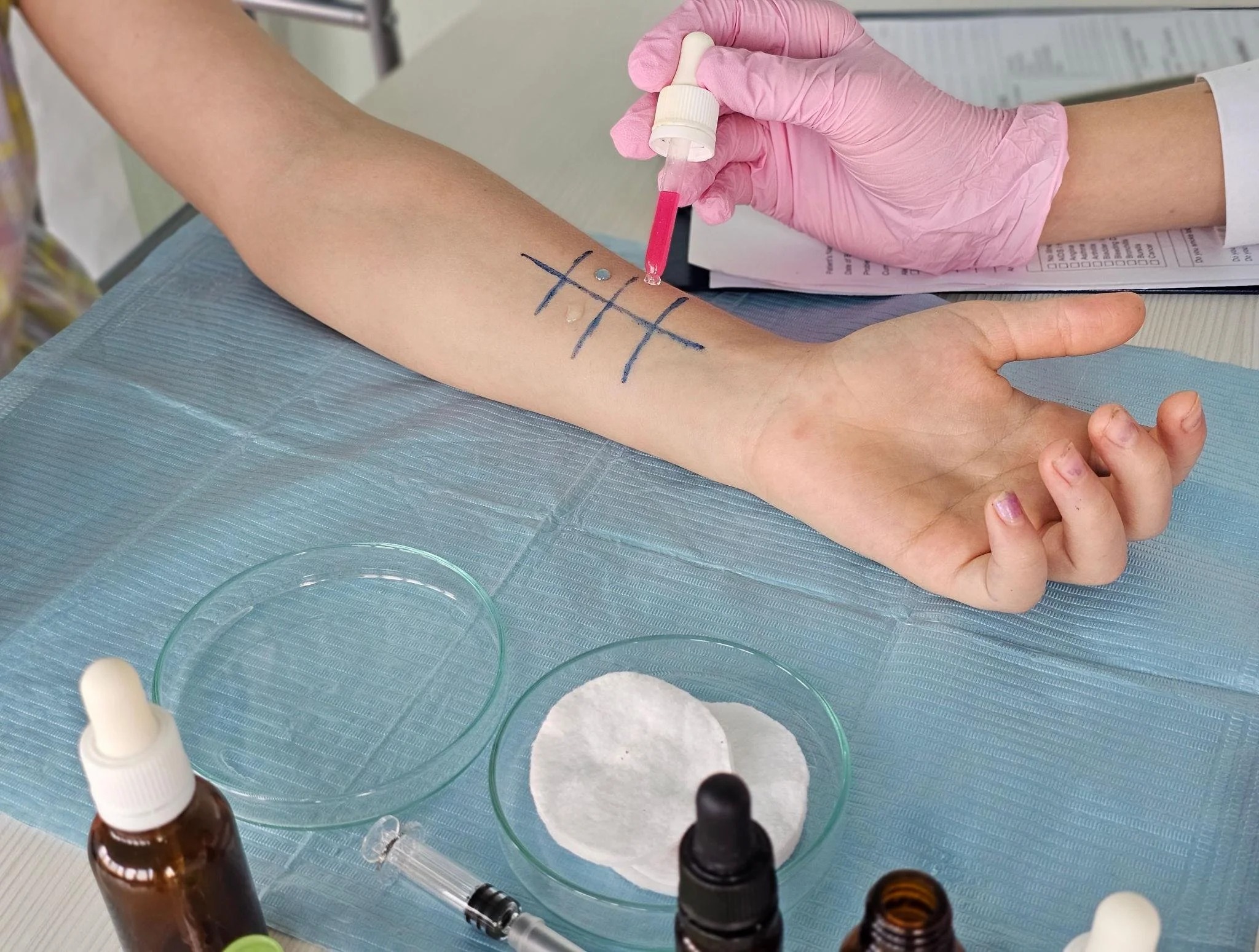 TB skin testing